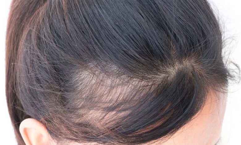 Ingredients in anti-hair loss shampoos