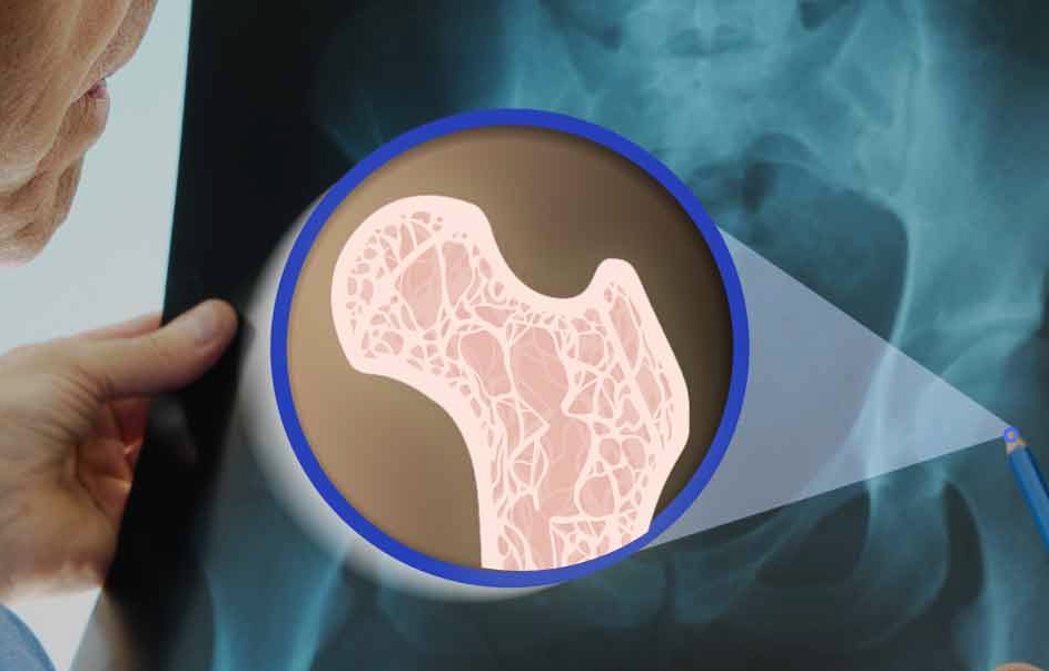 اصلی‌ترین عوامل دچار شدن به پوکی استخوان