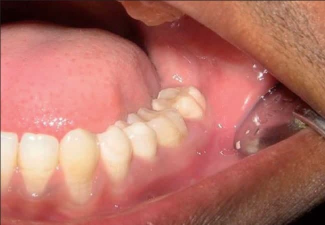 عکس عفونت دندان عقل