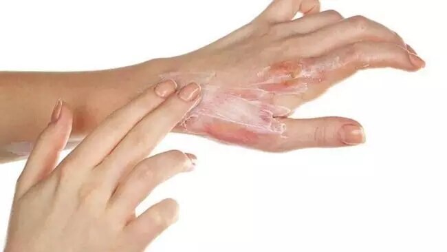 سوختگی پوست را در خانه با این روش درمان کنید
