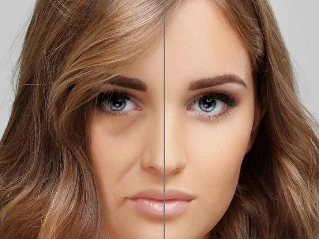 Persistence of fat injection in the face