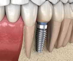 ایمپلنت | دندان پزشکی