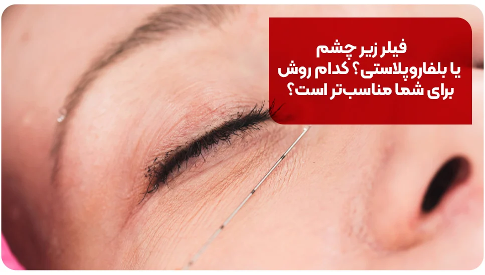 فیلر زیر چشم یا بلفاروپلاستی؟ کدام روش برای شما مناسب&zwnj;تر است؟