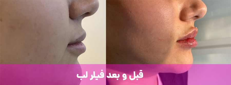 عکس قلب و بعد فیلر لب